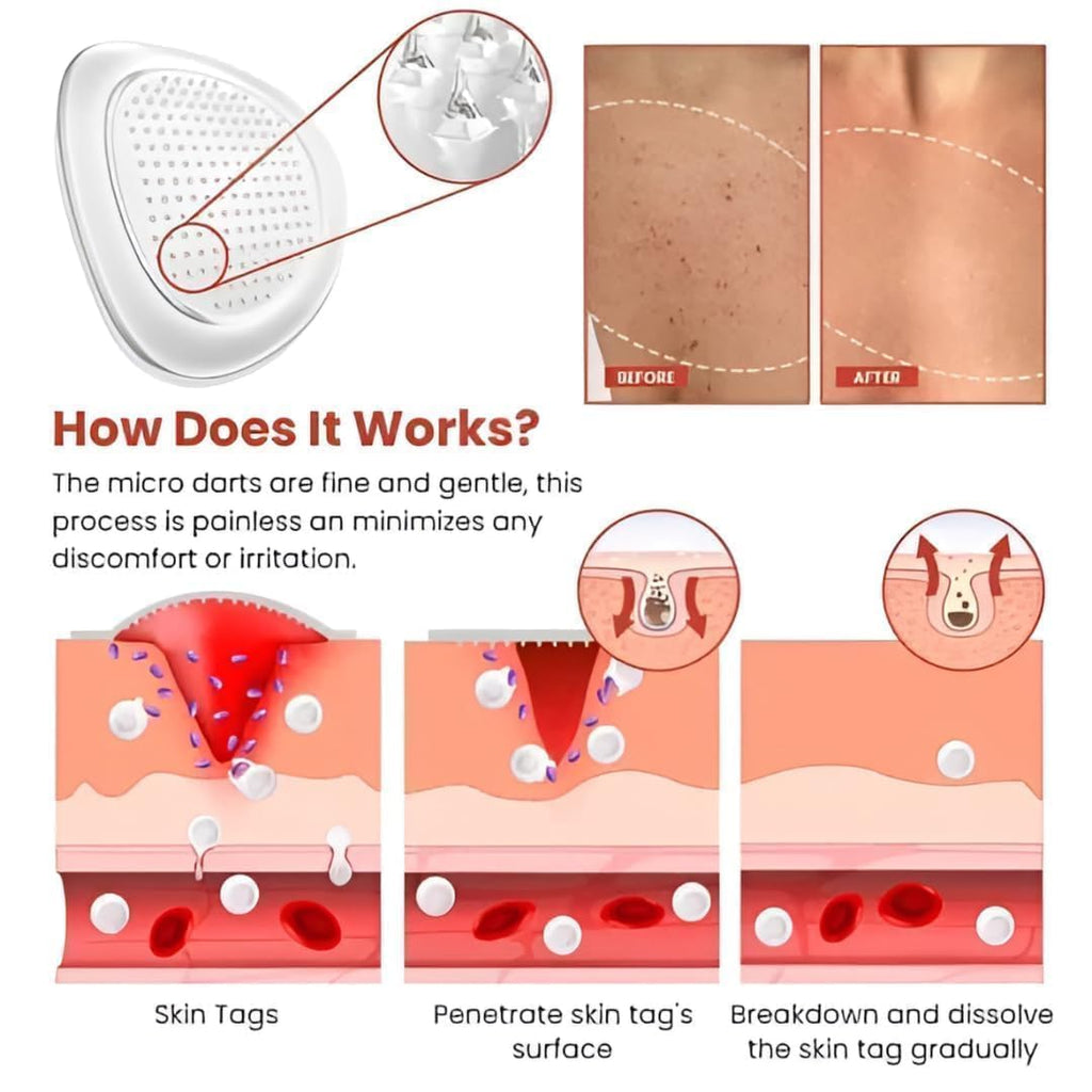 Skin Tag Remover Patch (Buy 1 Get 1 Free)