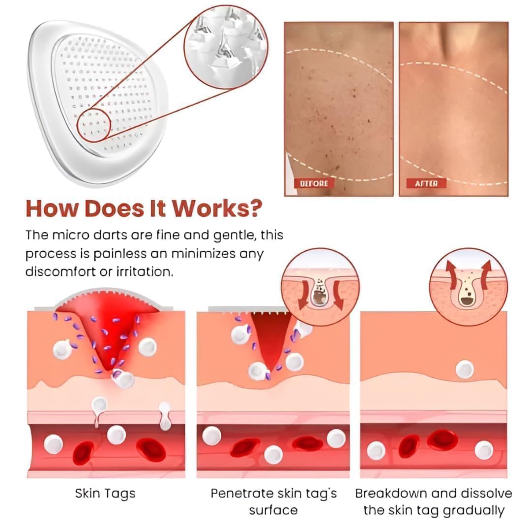 Skin Tag Remover Patch (Buy 1 Get 1 Free)